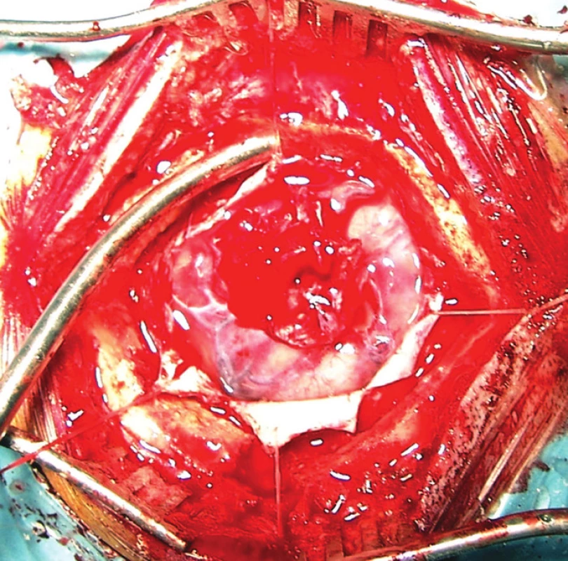 Rozsáhlá gliotická jizva s defektem tvrdé pleny v celém rozsahu této jizvy po trepanaci pro subdurální krvácení a kontuzi mozku v dětském věku provedené mimo neurochirurgické pracoviště.
Fig. 1: A large gliotic scar with a dura mater defect throughout the extent of this scar after trepanation for subdural bleeding and cerebral contusion in childhood performed outside a neurosurgical department.