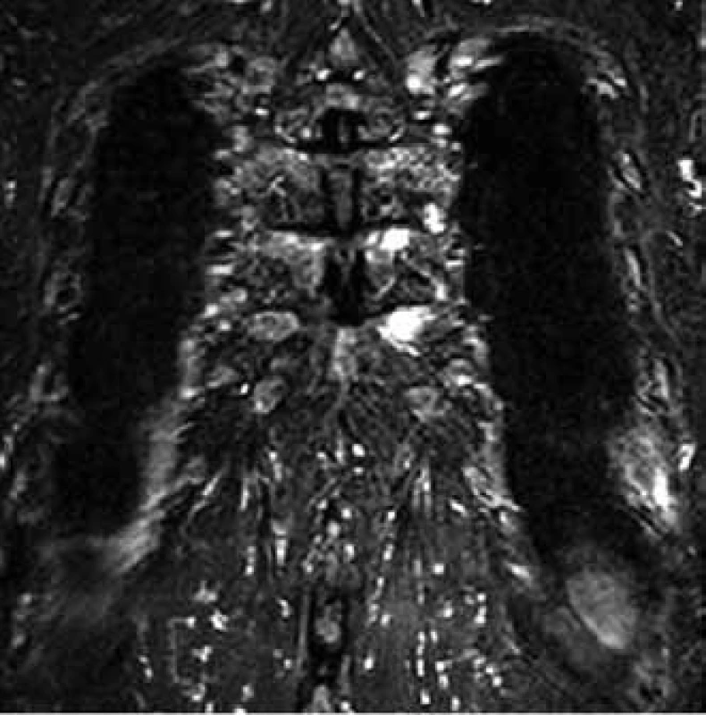MR image shows myeloma deposits in two medial ends of ribs on the left (the same patient as in the case of Fig. 6).