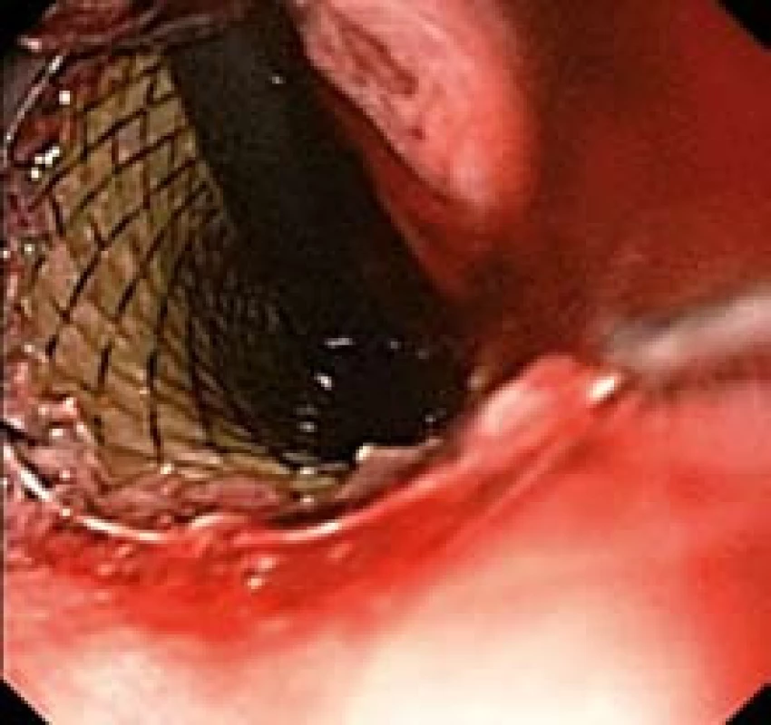Distální konec stentu po zavedení přesahující kardii (endoskopický obraz).
Fig. 10. Distal end of the stent after application overlapping cardia (endoscopic image).