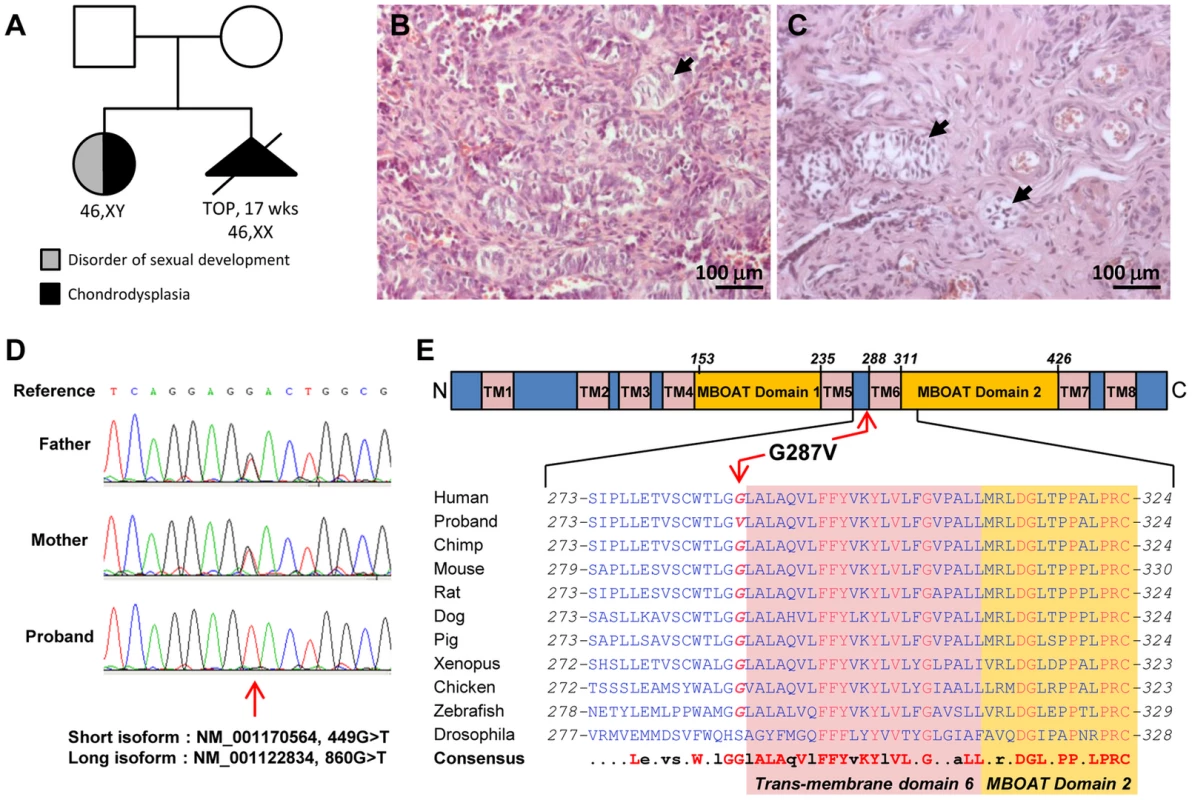 HHAT mutation in 46,XY DSD with chondrodysplasia.