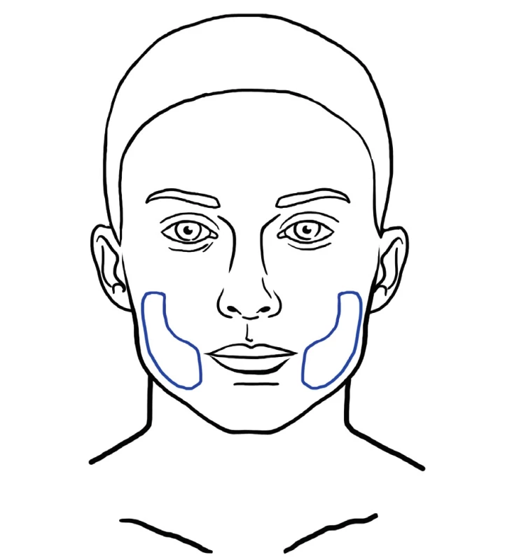 Example of area that may benefit from superficial microfat grafting