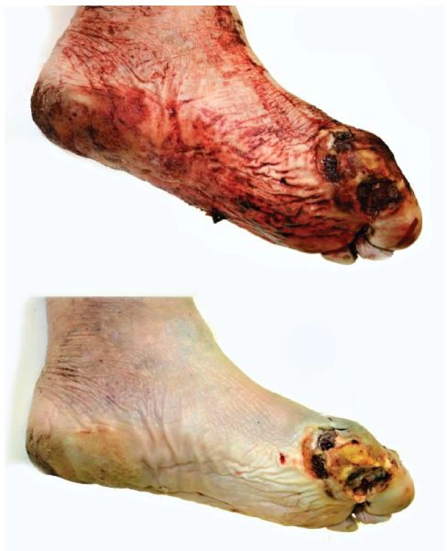 Skupina vředovitých defektů pod základním článkem palce levé nohy. Nahoře stav před omytím.