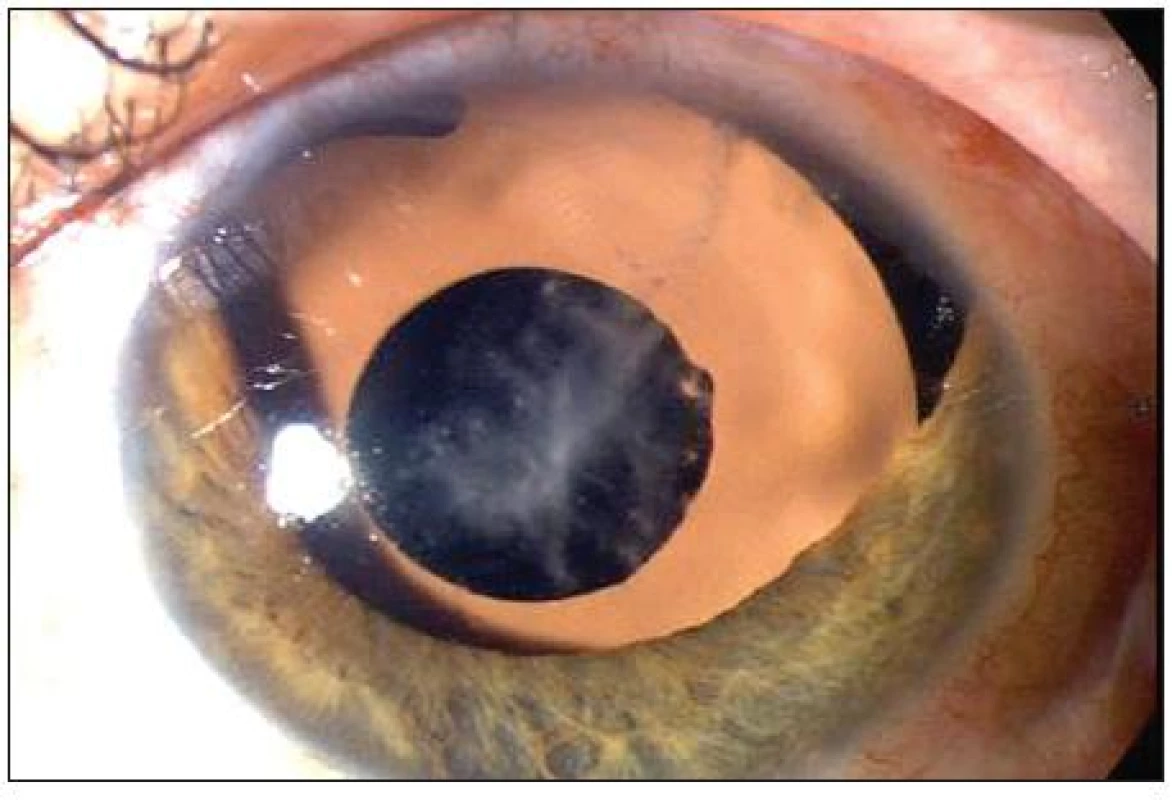 Nález po implantaci hnědé PC IOL Ophtec