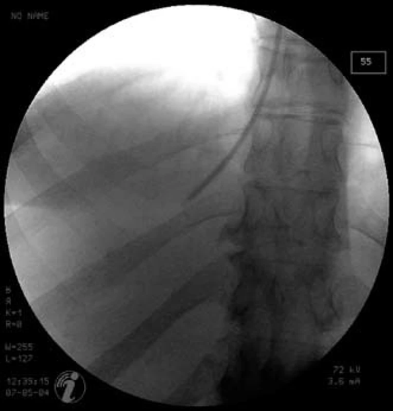 Skiaskopický obrázek provedení transjugulární jaterní biopsie – bioptická jehla v pravé jaterní žíle v pozici před samotným vpichem
Fig. 1. X-ray imaging of the transjugular liver biopsy – biopsy needle is placed in the right hepatic vein; position just before the puncture.