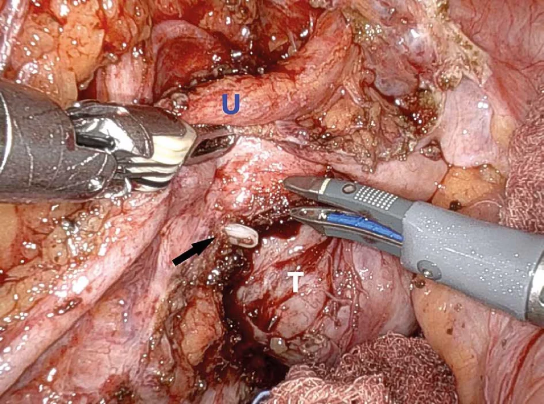 Peroperační snímek, situace po uvolnění tumoru z větví vnitřní ilické tepny vlevo; (U – levý ureter, T− tumor, šipka – klip na větvi levé vnitřní ilické tepny)