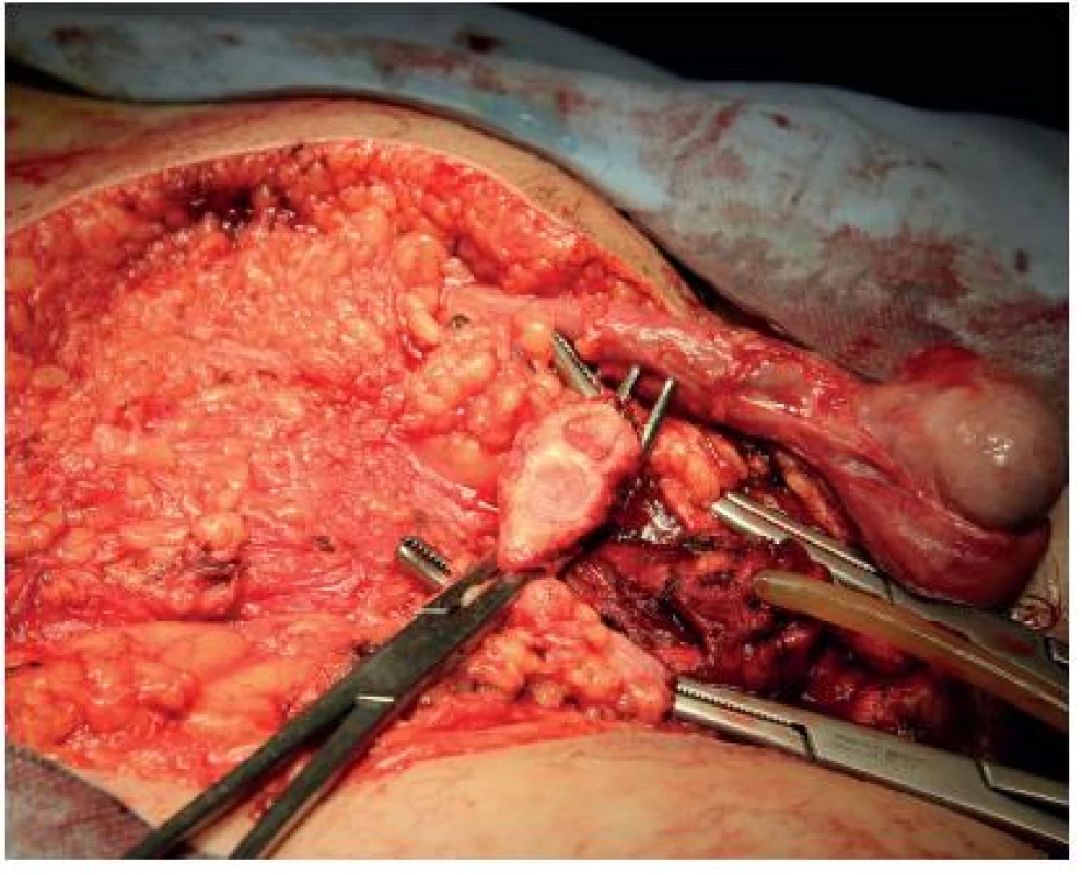 Peroperační snímek, rozsah resekční plochy
Fig. 7. Peroperative foto, resection area