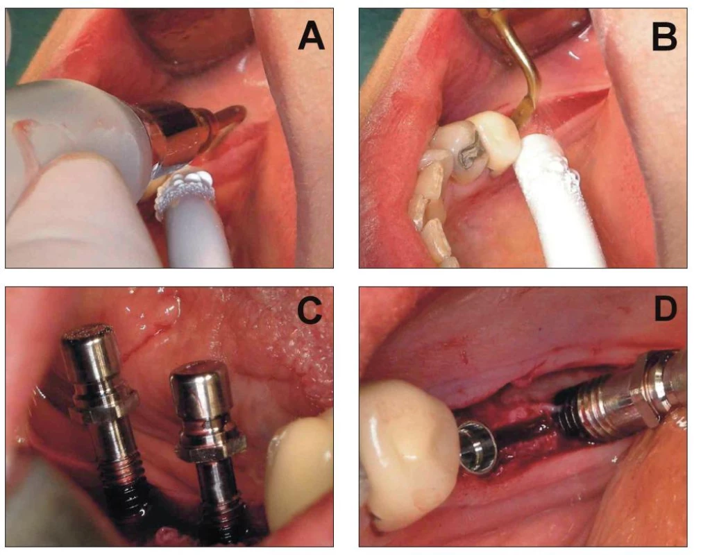 Bone splitting s použitím piezochirurgie.