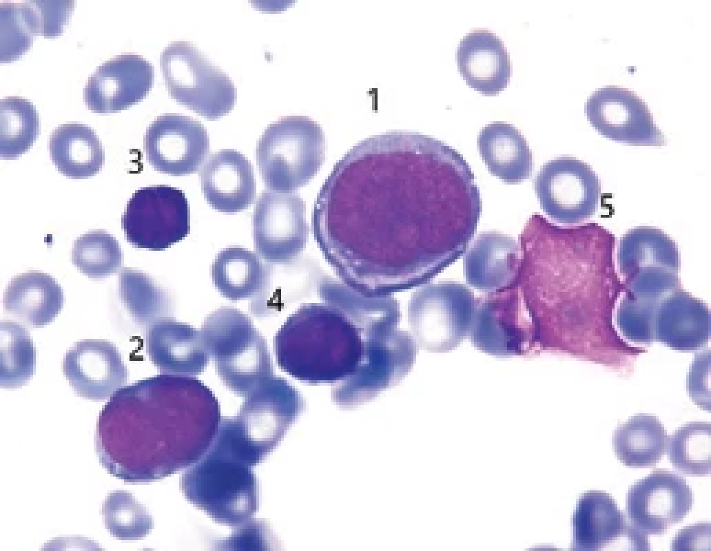 Cytologie kostní dřeně před léčbou (FNHK, IV. interní hematologická klinika, hematologická laboratoř).