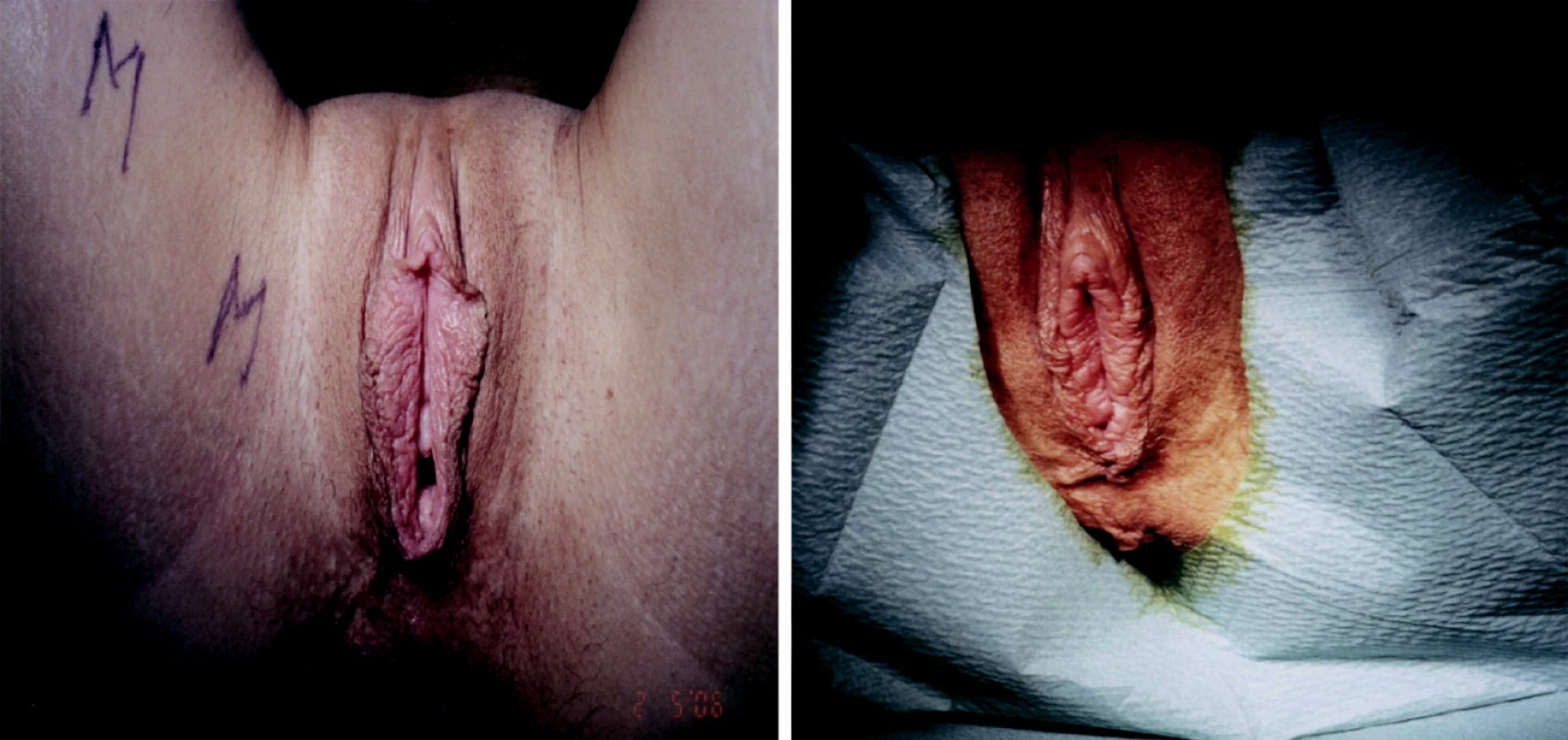 Stav před a těsně po úpravě velikosti poševního vchodu estetickou cestou (foto z archivu J. Války.)