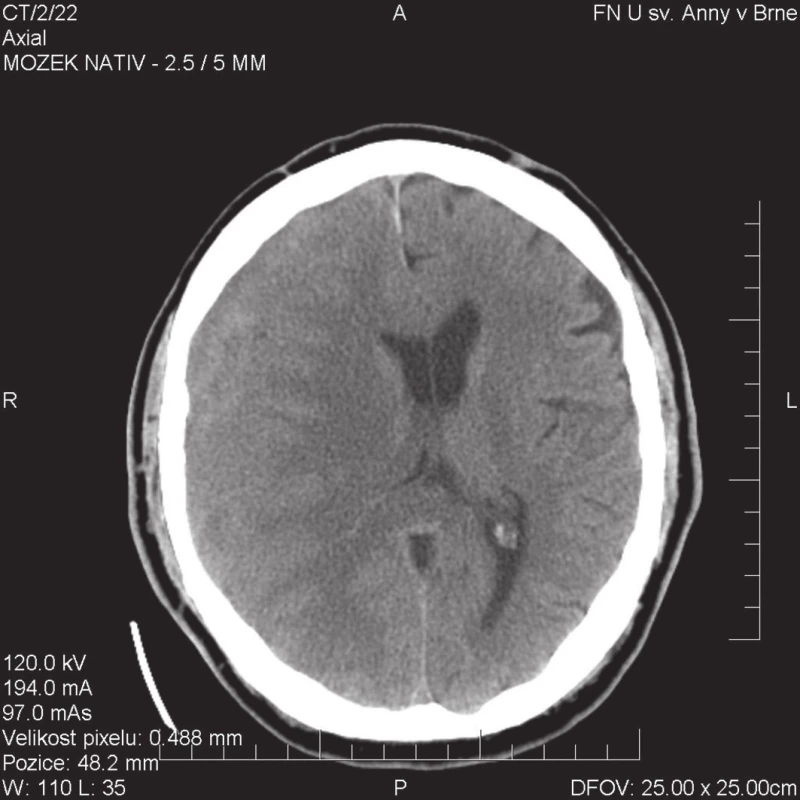 CT obraz izodenzního hematomu pokrývajícího celou pravou hemisféru mozku; na možnost komprese mozku upozorňuje přetlak pravé postranní komory
Fig. 1: CT image of isodense chronic subdural haematoma extending over the entire right hemisphere; the shift of the right ventricle compression should lead to the suspicion of brain compression