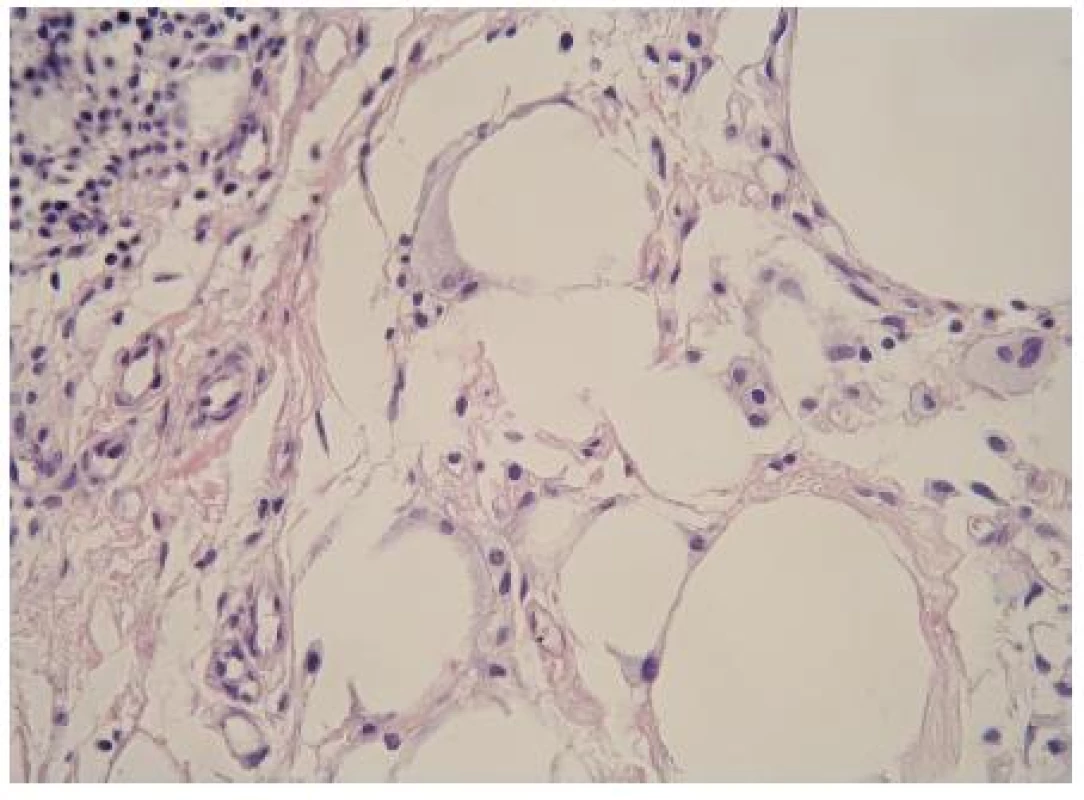 Histologický obraz před léčbou kortikoidy (HE, zvětšeno 40×)