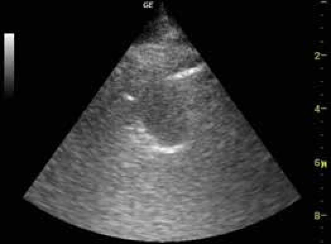Periferní plicní tumor