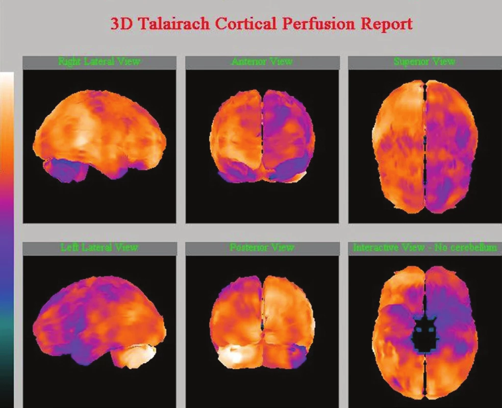 SPECT mozku – ukázka bazální a zátěžové studie (dipyridamolový test); hodnocení semikvantitativní programem NeuroGam<sup>TM</sup>Segami. Významně snížená CVR oboustranně u 76leté pacientky po recidivující iCMP (vlevo a dole).