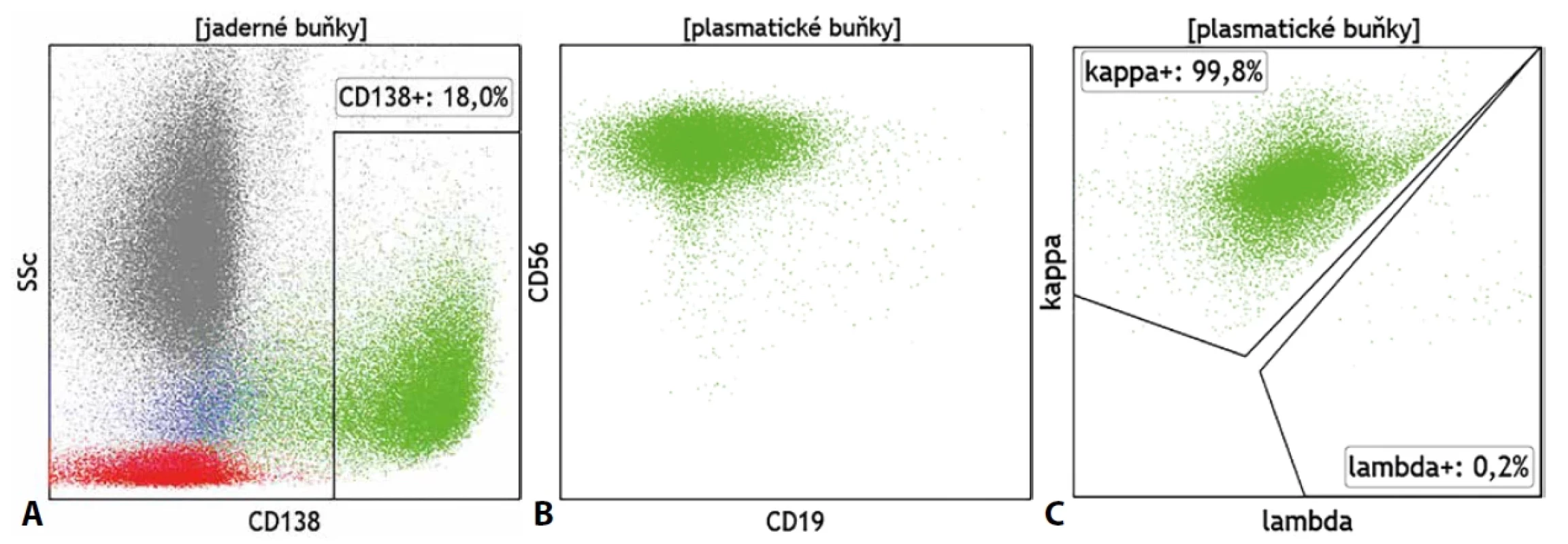 Exprese (A) znaku CD138, (B) aberantní fenotyp (CD19-/CD56+) a (C) monoklonální charakter určený výlučnou cytoplazmatickou expresí Ig κ na plazmatických buňkách u mnohočetného myelomu.