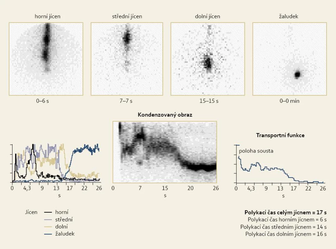 Příklad prodlouženého MTT a antiperistaltiky.
Fig. 5. Example of MTT prolongation and antiperistalsis.