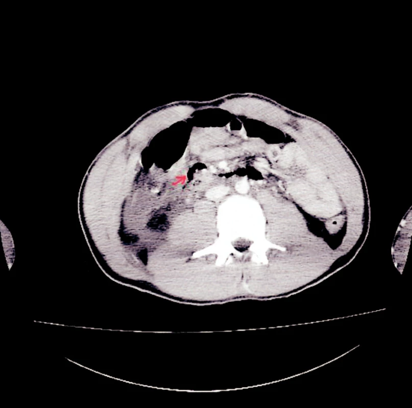 CT snímek – pneumoretroperitoneum
Fig. 3. CT view – pneumoretroperitoneum