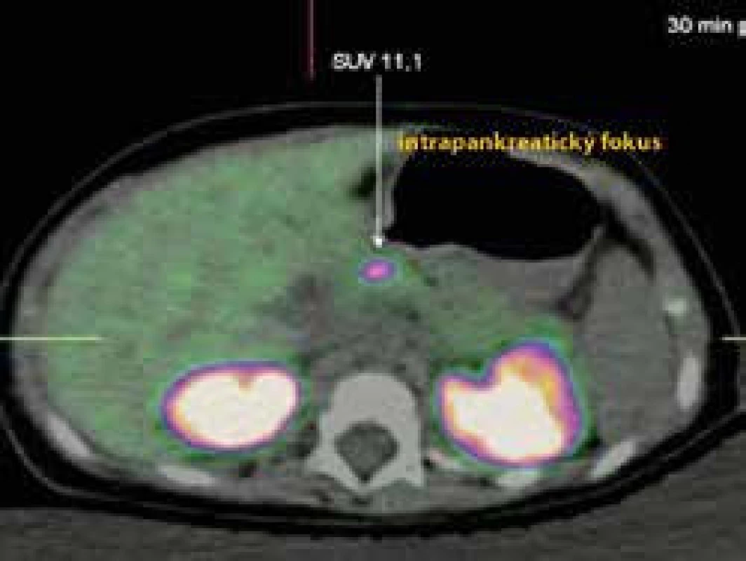 PET-CT u pacientky s fokálnou formou CHI