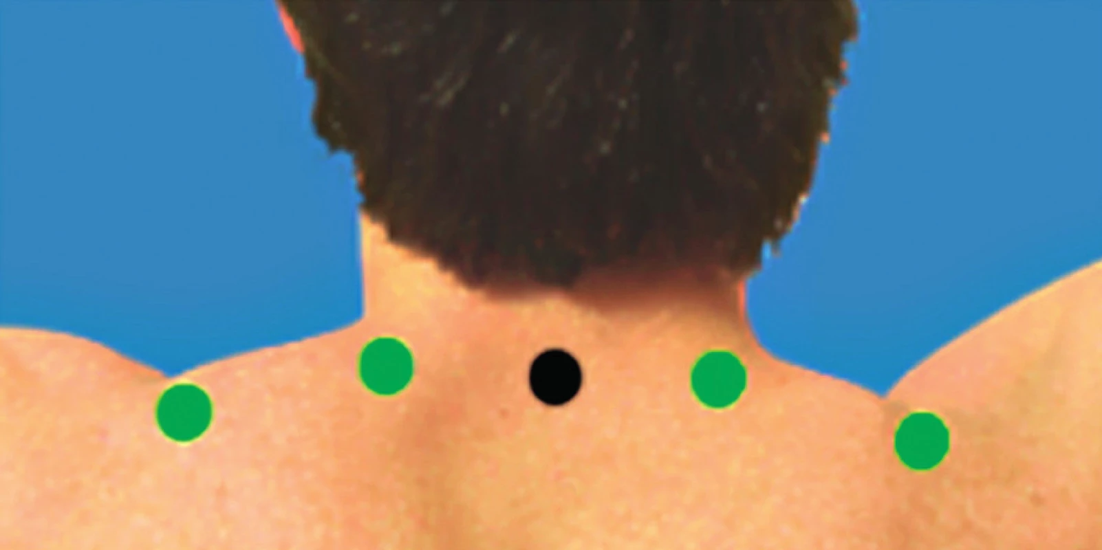 Umiestnenie elektród v oblasti m. trapezius.