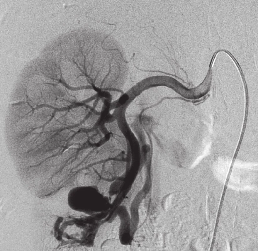Arteriografi e po translumbální resekci tumoru pravé ledviny Zobrazena mohutná větev pro kaudální renální segmenty, na kterou navazuje asi 2,5 cm pseudoaneuryzma a AV píštěl.
Fig. 4. Arteriography after a translumbal tumor resection of the right kidney Image of a massive branch for caudal renal segments, which continues with approximately 2,5 cm long pseudoaneurysm and AV fi stula.