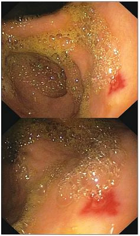 Fibroendoskopický obraz prisadlého polypoidného útvaru s ulceráciou na povrchu
Obr. 2. Sessile polypoid tumor with ulceration on the top