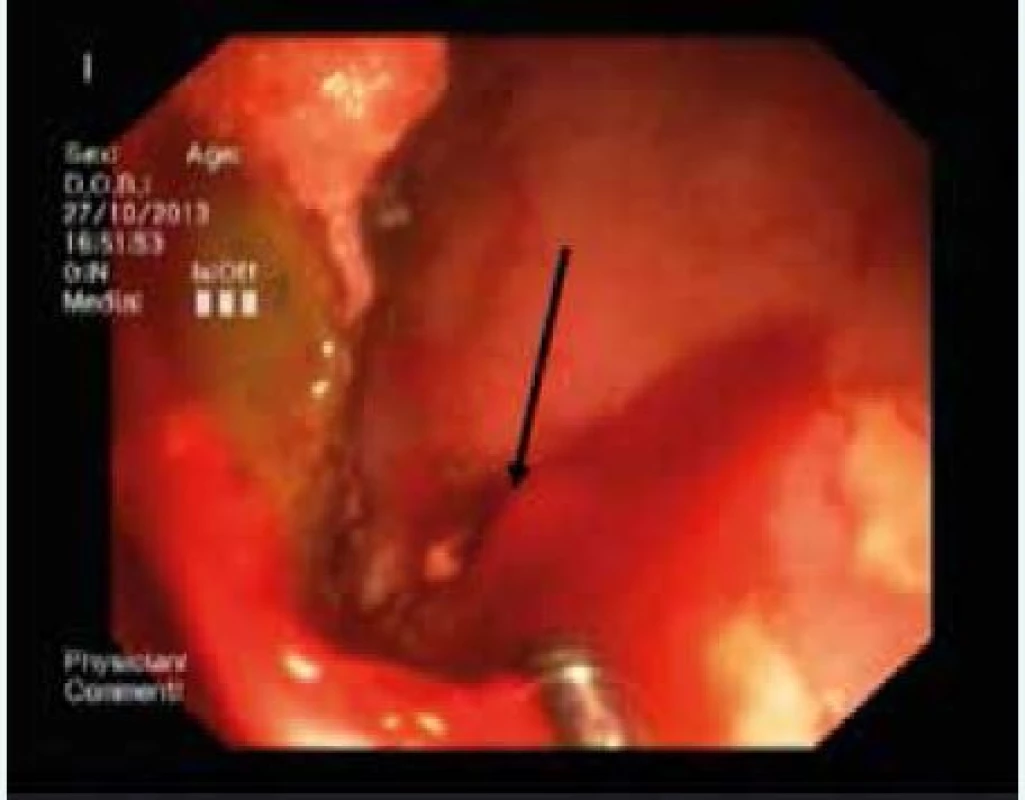 Tryskající, pulzující arteriální krvácení