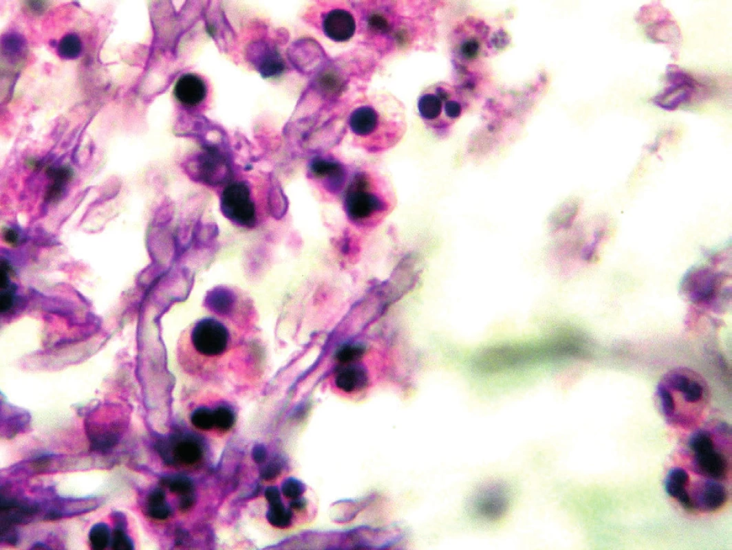 Aspergilová vlákna v histologickém preparátu, barvení hematoxylin-eosinem (Patologie Nemocnice Č. Budějovice, a. s.)
Figure 1. Aspergillus filaments in a hematoxylin-eosin stained histological sample (Pathology Service, České Budějovice Hospital, JSC)