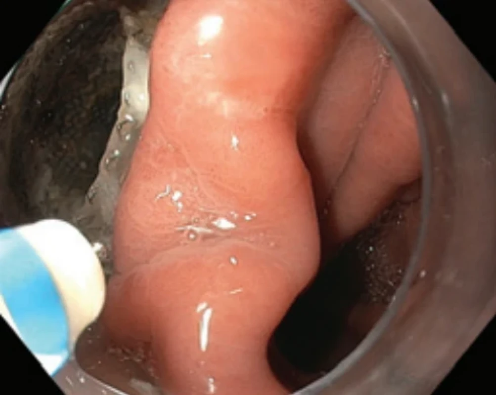 Stav před zahájením resekce septa nástrojem dual-knife. Fig. 2. Condition prior to resection of the septum using a dual-knife instrument.