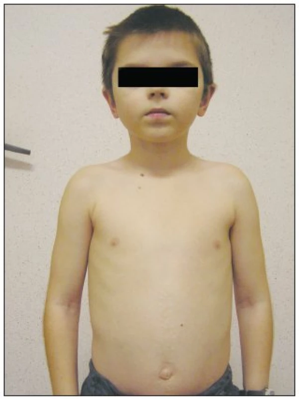 Dieťa 2 roky po operácii
Fig. 2. The child patient 2 years after the procedure
