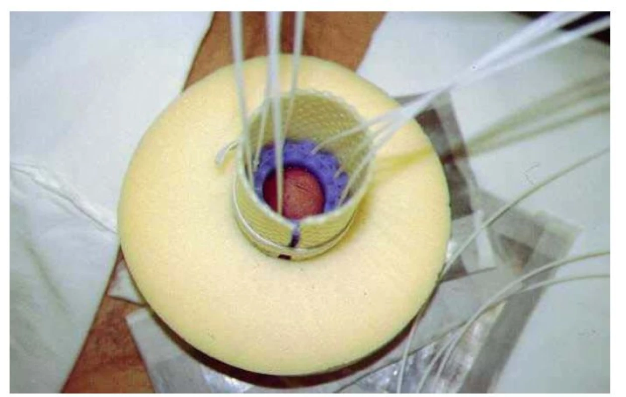 Povrchová HDR brachyterapie
Fig. 1. Superficial HDR brachytherapy of penile cancer