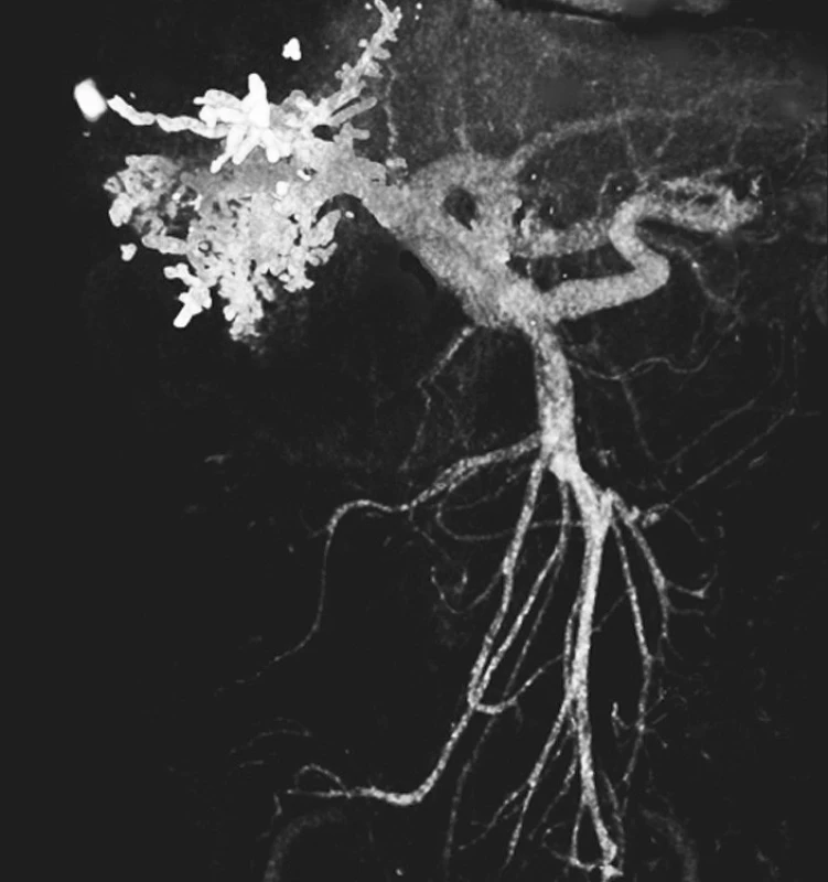 CT-portogram po úspěšném provedení pravostranné PVE Histoacrylem
Pic. 2. CT-portogram following successful completion of the right-sided PVE using Histoacryl