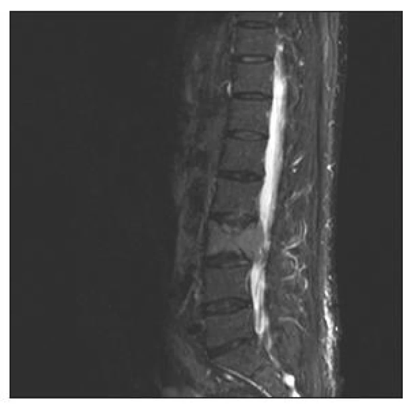 MR lumbosakrální páteře, sagitální sken, STIR zobrazení. Patologická fraktura obratle L3
Fig. 1. MRI, lumbosacral spine, sagittal view, STIR imaging. A pathological fracture of L3