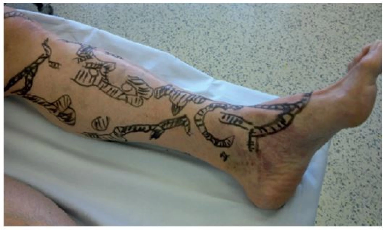 Varixy levé dolní končetiny
Fig. 2: Varicose veins – left lower limb