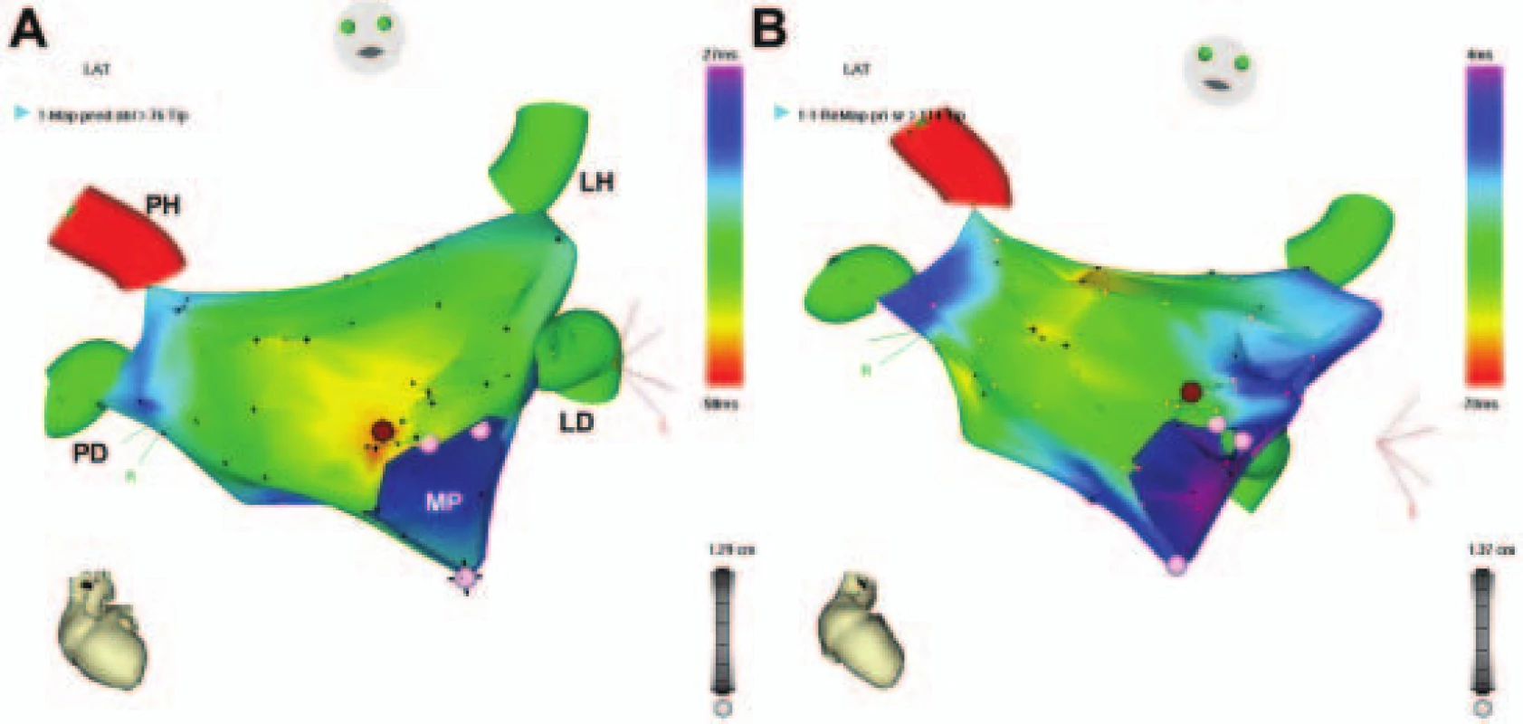Aktivační solidní elektroanatomická mapa fokální tachykardie z mitrálního prstence. 
Pohled na levou srdeční síň přibližně v předozadní projekci. V solidní aktivační elektroanatomické mapě znázorňuje v barevném spektru červená barva aktivaci nejčasnější a fialová barva aktivaci pozdní. Na obrázku A je výsledek mapování při běžící síňové tachykardii, kdy nejčasnější aktivace je zaznamenána těsně nad mitrálním prstencem anteroseptálně a odtud se šíří centrifugálně, přičemž pozdní aktivace (modrá-fialová) je na inferolaterální stěně levé síně a v oblasti pravých plicních žil. Hnědý bod označuje místo následné aplikace radiofrekvenční energie, která běžící tachykardii ukončila a trvale odstranila. Na obrázku B je solidní aktivační mapa u téže pacientky po ablaci tachykardie již při sinusovém rytmu. Nejčasnější aktivace (pronikající na levou síň z pravé srdeční síně) je v tomto případě zaznamenána na více místech mezisíňových spojení v posteriorní části síňové přepážky a nahoře v oblasti Bachmanova svazku. Vysvětlivky: viz obr. 2.