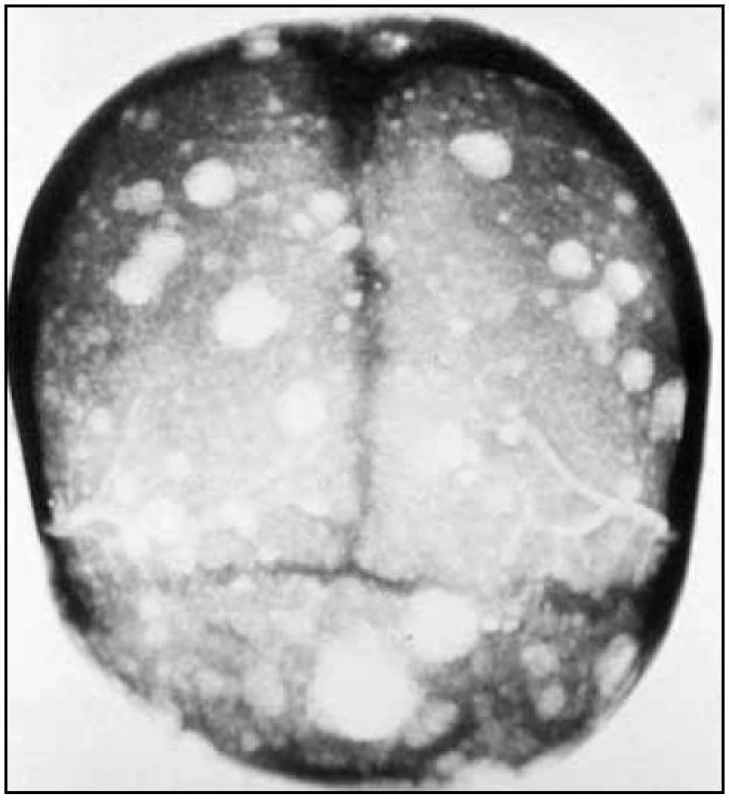 RTG lebky s osteolytickými ložisky u pacienta s mnohočetným myelomem.