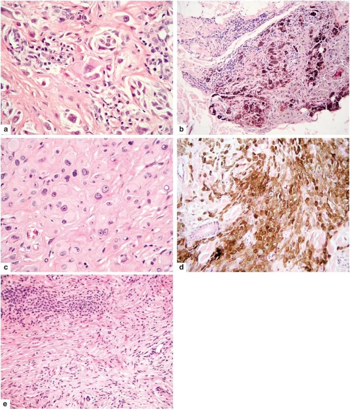 Hlavní cytologické varianty MELTUMP
a – spitzoidní
b – hluboko penetrující névus napodobující
c – epiteloidní
d – pigmentovaný epiteloidní melanocytom
e – desmoplastická