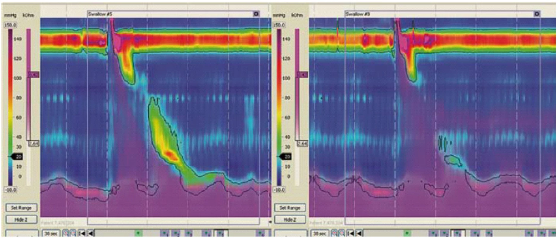 High-resolution manometrie s impedancí (ManoScan Z, Sierra Scientific Instruments).
Na levé části obr. je patrné polknutí s řádným očištěním jícnu. Bolus tekutiny je peristaltickou vlnou dopraven přes adek­vátně relaxovaný dolní jícnový svěrač do žaludku. Na pravé straně obr. je polknutí, jež nebylo efektivní. Reziduum tekutiny zůstává v distálním jícnu (fialová barva vpravo od peristaltické vlny).
Fig. 7. High-resolution manometry with impedance (ManoScan Z, Sierra Scientific Instruments).
Left: a swallowing with proper esophageal clearance. A liquid bolus is transported through an adequately relaxed lower esophageal sphincter to the stomach. Right: ineffective swallowing. Residue of a liquid bolus persists in the distal esophagus (­violet colour behind the peristaltic wave).