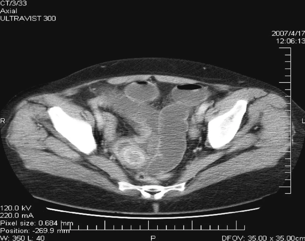 CT = hypodenzné ložisko v malej panve vpravo
Fig. 7. CT = a hypodense focus within the small pelvis on the right