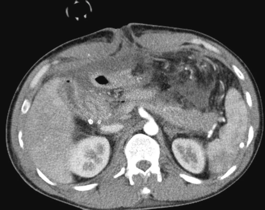 CT obraz poranění: Kavo-duodenální píštěl a poranění hlavy pankreatu
Fig. 1. CT view of the trauma: Cavo-duodenal fistule and the pancreatic head trauma