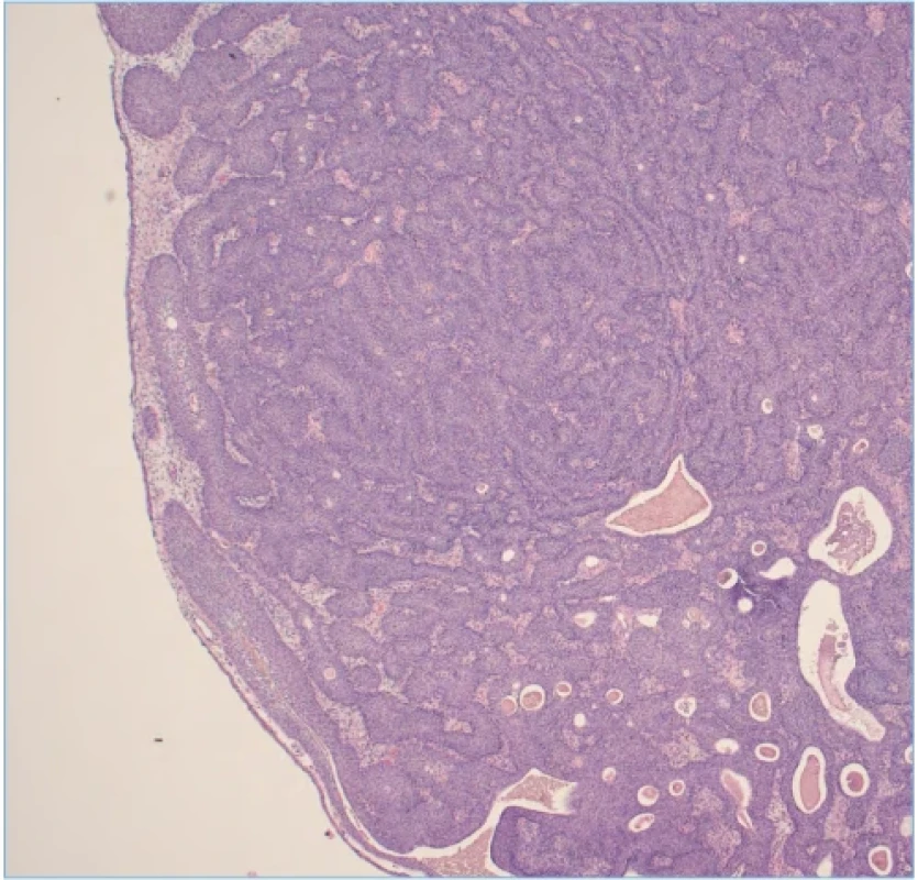 Histologie IUP (hematoxylin-eozin). Fig. 4. IUP histology (hematoxylin-eosin). 