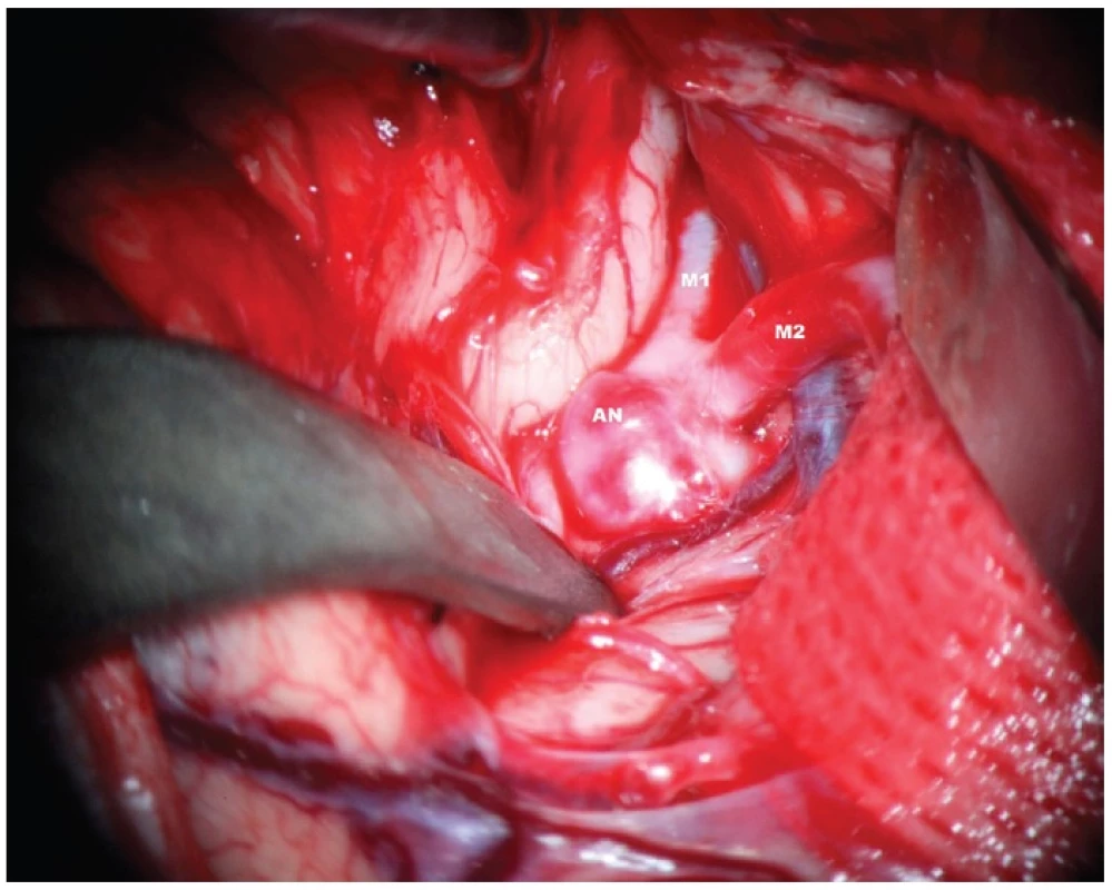 Disekce Sylvijské cisterny s patrným aneuryzmatem M1/2. AN – aneuryzma, M1 – kmen a. cerebri media. M2 – temporální větev bifurkace ACM
Fig. 2: Dissection of the Sylvian fissure – obvious aneurysm of MCA bifurcation. AN – aneurysm, M1 trunk of MCA, M2 temporal branch of MCA