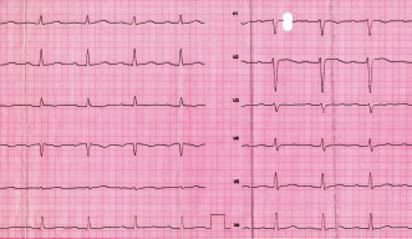 31ročná, doposiaľ zdravá pacientka, s poruchou vedomia pri ebriete. Laboratórny nález: etylalkohol 1,6 ‰, ostatné v norme. Na EKG AV blok I. stupňa, naznačené elevácie ST vo V1–2 (klinický materiál III. internej kliniky LF UPJŠ a FGN L. Pasteura Košice)