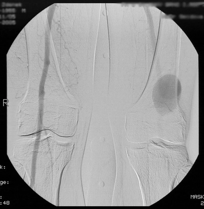 Peroperační RTG snímek implantovaného bifurkačního stentgraftu Zenith.
Pic. 3. Intraoperative X-ray of implanted stent graft Zenith.