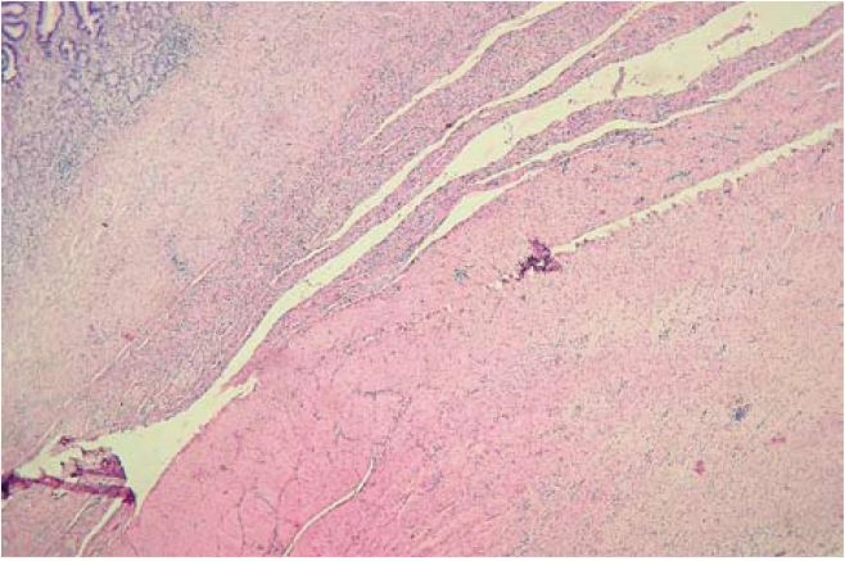 Histologický obraz jizvy zhojené v celé šíři stěny žaludku.
Fig. 4. Histological image of the healed scar in the whole abdominal wall width.