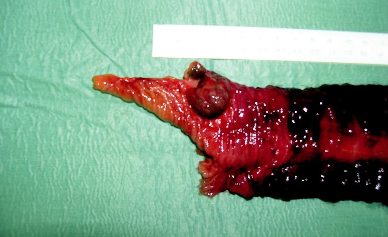 Stopkatý tumor distálního ilea – maligní melanom
Fig. 5. The stem tumor of the distal ileum – melanoma malignum