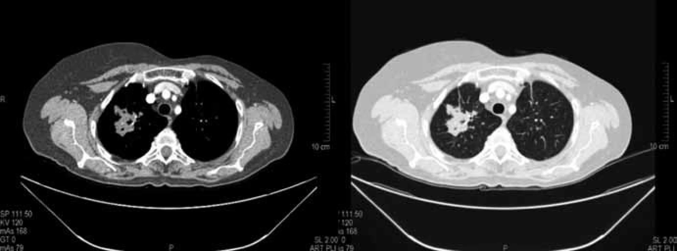 Kontrolní CT vyšetření plic po 3 měsících chemobioterapie v březnu 2010. Součet cílových lézí dle RECIST 65 mm (–23,5 %) splňující kritéria stabilizace nemoci (SD).