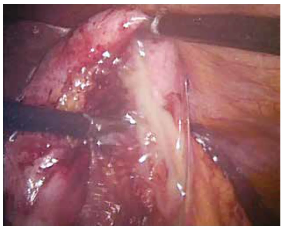 Perforace flegmonózního žlučníku s empyémem<br>
Fig. 5: Perforation of phlegmonous gallbladder with empyema