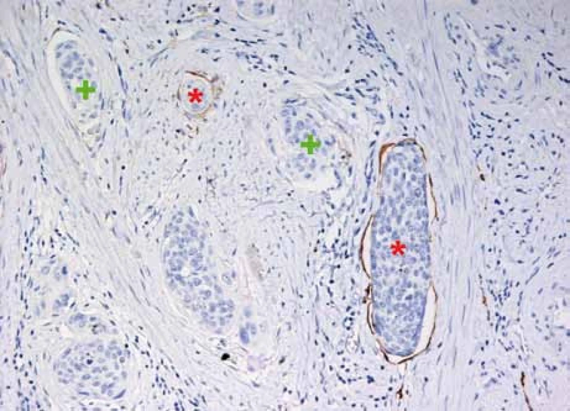Imunohistochemické značení lymfatických cév detekcí podoplaninu pomáhá odlišit lymfovaskulární invazi spinocelulárního karcinomu (čepy značené*) od čepů s retrakčními artefakty (značeno +). D2.40, Dako, 400krát zvětšení, foto Masarykův onkologický ústav.