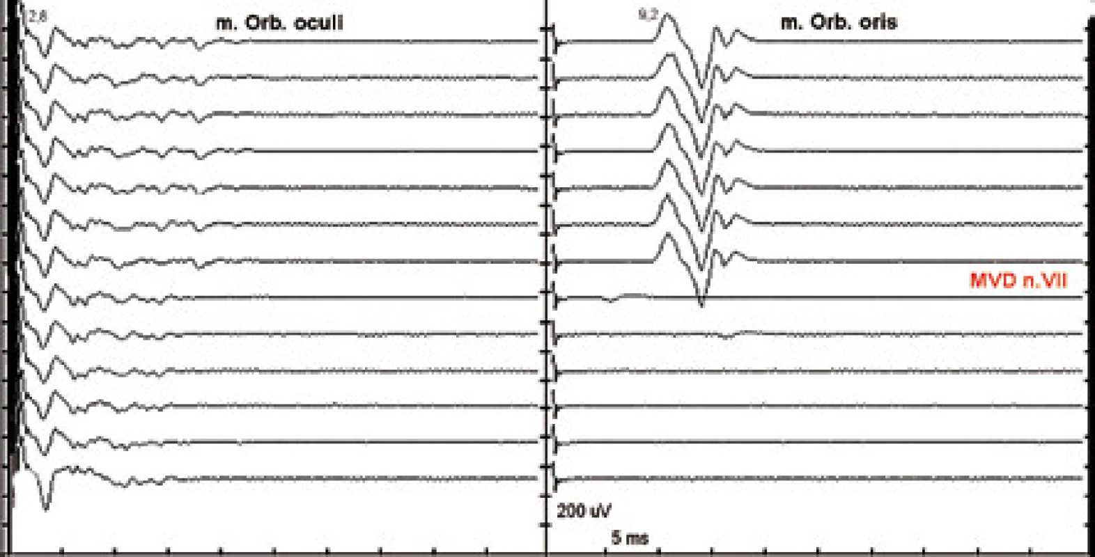Ztráta nepřímé odpovědi při mikrovaskulární dekompresi n. VII.
Stimulace r. zygomaticus, registrace m. orb. oculi (vlevo) a m. orb. oris (vpravo), jeden záznam každých 30 s. Normální CMAP m. orb. oculi při stimulaci r. zygomaticus. Abnormní CMAP konstantně výbavná před MVD. Po provedení MVD abnormní odpověď z m. orb. oris vymizela.