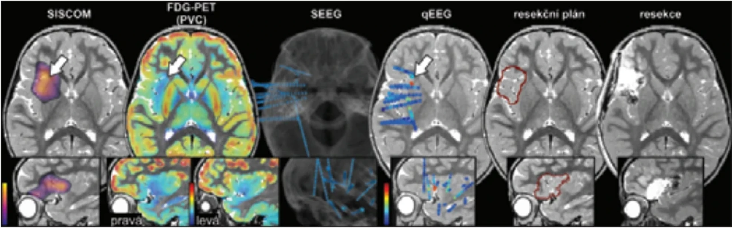 Multimodální zobrazení výsledků neinvazivních a následně indikovaných invazivních vyšetření u dítěte s operkulo-inzulární MR- -negativní epilepsií na podkladě fokální kortikální dysplazie typu I vedoucích k úspěšné resekční epileptochirurgii (převzato z práce [69]).  Fig. 4. Multimodal visualization of the results of noninvasive and subsequently indicated invasive investigations in a child with operculoinsular MR-negative epilepsy due to focal cortical dysplasia type I, leading to successful resective epilepsy surgery (adapted from [69]).