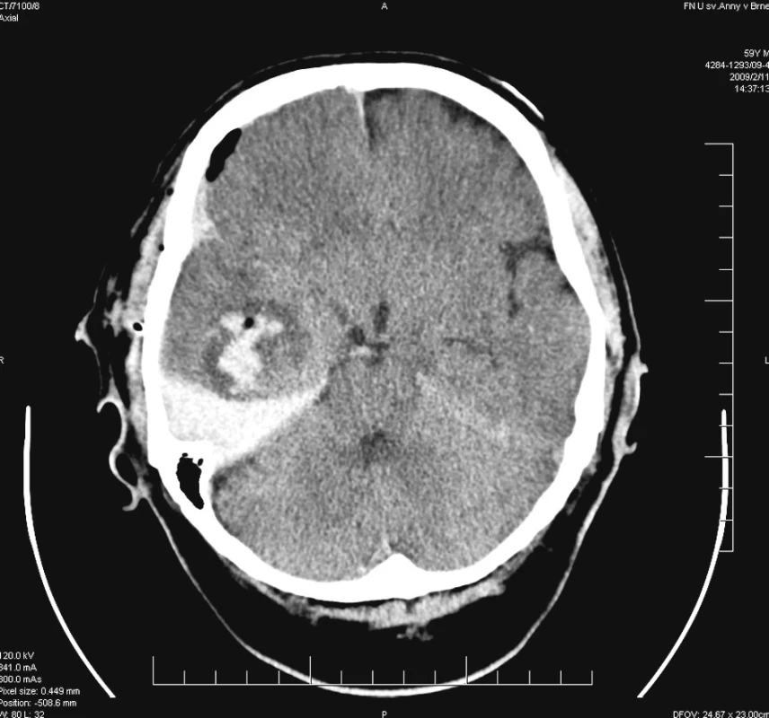 Stav po aspiraci intracerebrálního hematomu – reziduální nehomogenní prokrvácená tkáň s kolekcí krve na bázi střední jámy lební
Pic. 2. Situation after intracerebral haematoma aspiration – residual non bloody homogenous tissue with subdural blood collection on the middle fossa floor